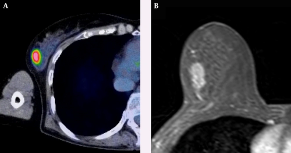 A 63-year-old woman with HER2-positive subtype breast cancer. A, Axial F-18 positron emission tomography/computed tomography (PET/CT) and B, Dynamic contrast-enhanced MR images show intense Fluorine-18 fluorodeoxyglucose (F-18 FDG) uptake (tumor maximum standard uptake value (SUVmax): 8.25, and tumor-to-liver SUV ratio: 2.93) in a 17-mm right breast mass confirmed to be an invasive ductal carcinoma. A 63-year-old woman with HER2-positive subtype breast cancer. A, Axial F-18 positron emission tomography/computed tomography (PET/CT) and B, Dynamic contrast-enhanced MR images show intense Fluorine-18 fluorodeoxyglucose (F-18 FDG) uptake (tumor maximum standard uptake value (SUVmax): 8.25, and tumor-to-liver SUV ratio: 2.93) in a 17-mm right breast mass confirmed to be an invasive ductal carcinoma.