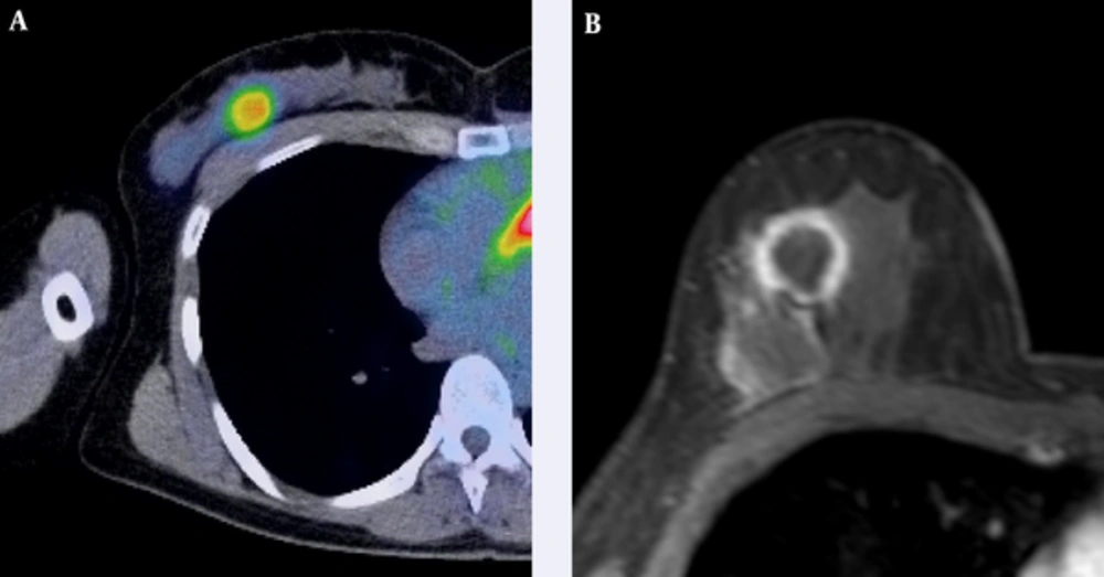 A 52-year-old woman with triple-negative subtype breast cancer. A, Axial F-18 positron emission tomography/computed tomography (PET/CT) and B, Dynamic contrast-enhanced MR images show intense Fluorine-18 fluorodeoxyglucose (F-18 FDG) uptake (tumor maximum standard uptake value (SUVmax): 4.31, tumor-to-liver SUV ratio: 1.93) in a 25-mm right breast mass that was confirmed as an invasive ductal carcinoma. A 52-year-old woman with triple-negative subtype breast cancer. A, Axial F-18 positron emission tomography/computed tomography (PET/CT) and B, Dynamic contrast-enhanced MR images show intense Fluorine-18 fluorodeoxyglucose (F-18 FDG) uptake (tumor maximum standard uptake value (SUVmax): 4.31, tumor-to-liver SUV ratio: 1.93) in a 25-mm right breast mass that was confirmed as an invasive ductal carcinoma.