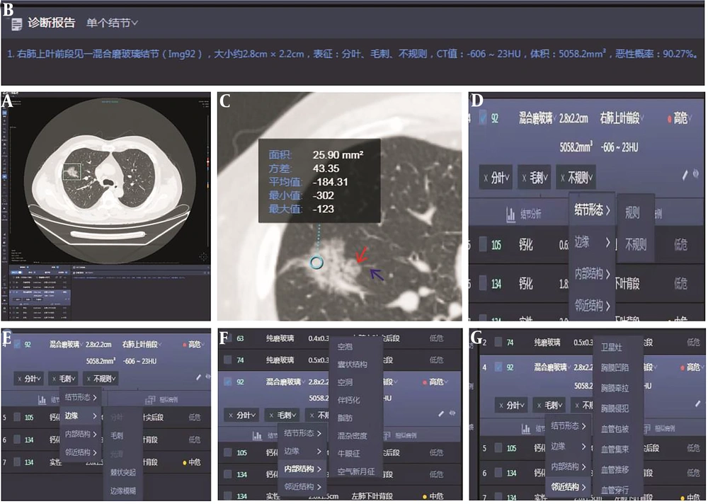 Artificial intelligence automatically screens pulmonary ground-glass nodules (GGNs). A and B, A 56-year-old man with a mixed GGN of the anterior segment of the right upper lobe of the lung, with a size of about 2.8 × 2.2 cm, a CT value of 606 23 HU, a volume of 5058.2 mm<sup>3</sup>, and a malignant probability of 90.27%. C, The region of interest extraction (indicated by blue circle), lobation (indicated by red arrow), and spiculation (indicated by blue arrow). Artificial intelligence automatically extracts features such as D, morphology; E, margin; F, internal structures; and G, surrounding structures. Artificial intelligence automatically screens pulmonary ground-glass nodules (GGNs). A and B, A 56-year-old man with a mixed GGN of the anterior segment of the right upper lobe of the lung, with a size of about 2.8 × 2.2 cm, a CT value of 606 23 HU, a volume of 5058.2 mm<sup>3</sup>, and a malignant probability of 90.27%. C, The region of interest extraction (indicated by blue circle), lobation (indicated by red arrow), and spiculation (indicated by blue arrow). Artificial intelligence automatically extracts features such as D, morphology; E, margin; F, internal structures; and G, surrounding structures.