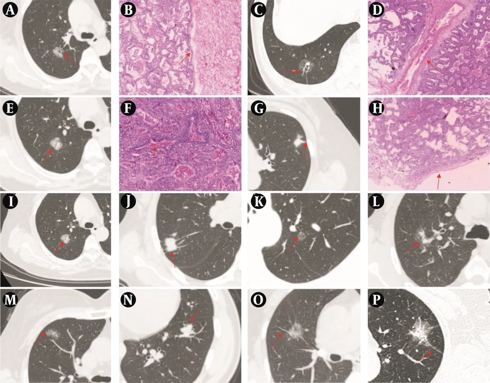 A, Representative CT image showing a mixed ground-glass nodule (mGGN) in the upper lobe of the right lung, with the red arrow indicating the sign of interlobular septal obstruction. B, Representative image of hematoxylin and eosin staining confirming invasive adenocarcinoma (IAC) pathologically (H&E, ×40). C, Representative CT image showing a pure ground-glass nodule (pGGN) in the lower lobe of the right lung, with the red arrow indicating the sign of vascular penetration. D, Representative image of hematoxylin and eosin staining confirming IAC pathologically (H&E, ×40). E, Representative CT image showing a mGGN in the upper lobe of the right lung, with the red arrow indicating the sign of air bronchogram. F, Representative image of hematoxylin and eosin staining confirming IAC pathologically (H&E, ×40). G, Representative CT image showing a mGGN in the upper lobe of the left lung, with the red arrow indicating the sign of pleural indentation. H, Representative image of hematoxylin and eosin staining confirming IAC pathologically (H&E, ×40). I - P, Representative CT images showing the sign of vacuole, the sign of vascular convergence, the sign of superficial lobulation, the sign of deep lobulation, the sign of short and thin spiculation, the sign of short and thick spiculation, the sign of tall and thin spiculation, the sign of tall and thick spiculation, with the red arrow indicating the sign in each panel. A, Representative CT image showing a mixed ground-glass nodule (mGGN) in the upper lobe of the right lung, with the red arrow indicating the sign of interlobular septal obstruction. B, Representative image of hematoxylin and eosin staining confirming invasive adenocarcinoma (IAC) pathologically (H&E, ×40). C, Representative CT image showing a pure ground-glass nodule (pGGN) in the lower lobe of the right lung, with the red arrow indicating the sign of vascular penetration. D, Representative image of hematoxylin and eosin staining confirming IAC pathologically (H&E, ×40). E, Representative CT image showing a mGGN in the upper lobe of the right lung, with the red arrow indicating the sign of air bronchogram. F, Representative image of hematoxylin and eosin staining confirming IAC pathologically (H&E, ×40). G, Representative CT image showing a mGGN in the upper lobe of the left lung, with the red arrow indicating the sign of pleural indentation. H, Representative image of hematoxylin and eosin staining confirming IAC pathologically (H&E, ×40). I - P, Representative CT images showing the sign of vacuole, the sign of vascular convergence, the sign of superficial lobulation, the sign of deep lobulation, the sign of short and thin spiculation, the sign of short and thick spiculation, the sign of tall and thin spiculation, the sign of tall and thick spiculation, with the red arrow indicating the sign in each panel.
