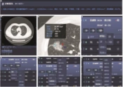 Diagnostic Value of Combined High-resolution Computed Tomography and Artificial Intelligence-Aided Diagnosis System in Prediction of Benign and Malignant Pulmonary Ground-Glass Nodules