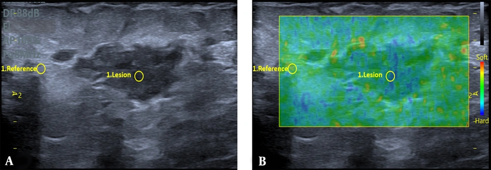 Grey-scale US (A) exhibits an irregular parallel mass with mild peripheral edema in a 29-year-old woman with a history of mastitis in the same breast over the past year. The strain elastography (B) indicates a strain ratio (SR) of 2.68, and the biopsy findings indicate an idiopathic granulomatous mastitis (IGM) lesion. Grey-scale US (A) exhibits an irregular parallel mass with mild peripheral edema in a 29-year-old woman with a history of mastitis in the same breast over the past year. The strain elastography (B) indicates a strain ratio (SR) of 2.68, and the biopsy findings indicate an idiopathic granulomatous mastitis (IGM) lesion.
