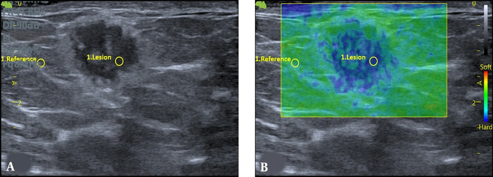 Grey-scale US (A) displays a round microlobulated mass with a thick halo in a 41-year-old woman. The mass appears stiff on strain elastography (B). The strain ratio (SR) is 4.76, and the lesion is shown to be invasive ductal carcinoma following core needle biopsy. Grey-scale US (A) displays a round microlobulated mass with a thick halo in a 41-year-old woman. The mass appears stiff on strain elastography (B). The strain ratio (SR) is 4.76, and the lesion is shown to be invasive ductal carcinoma following core needle biopsy.