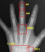 Cover image of the article: Improvement of Bone Age Assessment Using a Deep Learning Model in Young Children: Significance of Carpal Bone Analysis