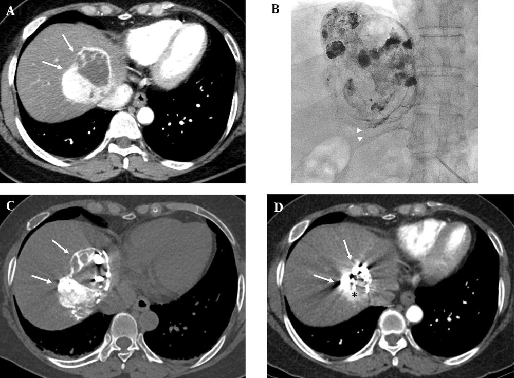 A 61-year-old female patient underwent surgery and radiation therapy for the solitary fibrous tumor in her brain 8 years ago. A, The arterial phase on computed tomography (CT) shows a 6.4 cm sized hypervascular tumor at the dome area of segment eight of the liver (arrows), which was biopsy proven as a hepatic metastasis from solitary fibrous tumor (arrows); B, Superselective catheterization of the tumor feeder was performed using a microcatheter (arrow heads). Transarterial chemoembolization was performed using adriamycin 30 mg, Lipiodol 8 cc, and gelatin sponge particles; heterogenous lipiodol uptake was observed in the post fluoroscopy image; C, Postprocedural lipiodol CT showed compact lipiodol uptake in the enhancing portion of the tumor (arrows); D, In the arterial phase of the follow-up CT 4 months after the procedure, the size of tumor decreased by 23.4% from 6.4 cm to 4.9 cm; however, arterial enhancement remained (arrows), which suggests that the lesion is a viable tumor (black asterisk). A 61-year-old female patient underwent surgery and radiation therapy for the solitary fibrous tumor in her brain 8 years ago. A, The arterial phase on computed tomography (CT) shows a 6.4 cm sized hypervascular tumor at the dome area of segment eight of the liver (arrows), which was biopsy proven as a hepatic metastasis from solitary fibrous tumor (arrows); B, Superselective catheterization of the tumor feeder was performed using a microcatheter (arrow heads). Transarterial chemoembolization was performed using adriamycin 30 mg, Lipiodol 8 cc, and gelatin sponge particles; heterogenous lipiodol uptake was observed in the post fluoroscopy image; C, Postprocedural lipiodol CT showed compact lipiodol uptake in the enhancing portion of the tumor (arrows); D, In the arterial phase of the follow-up CT 4 months after the procedure, the size of tumor decreased by 23.4% from 6.4 cm to 4.9 cm; however, arterial enhancement remained (arrows), which suggests that the lesion is a viable tumor (black asterisk).