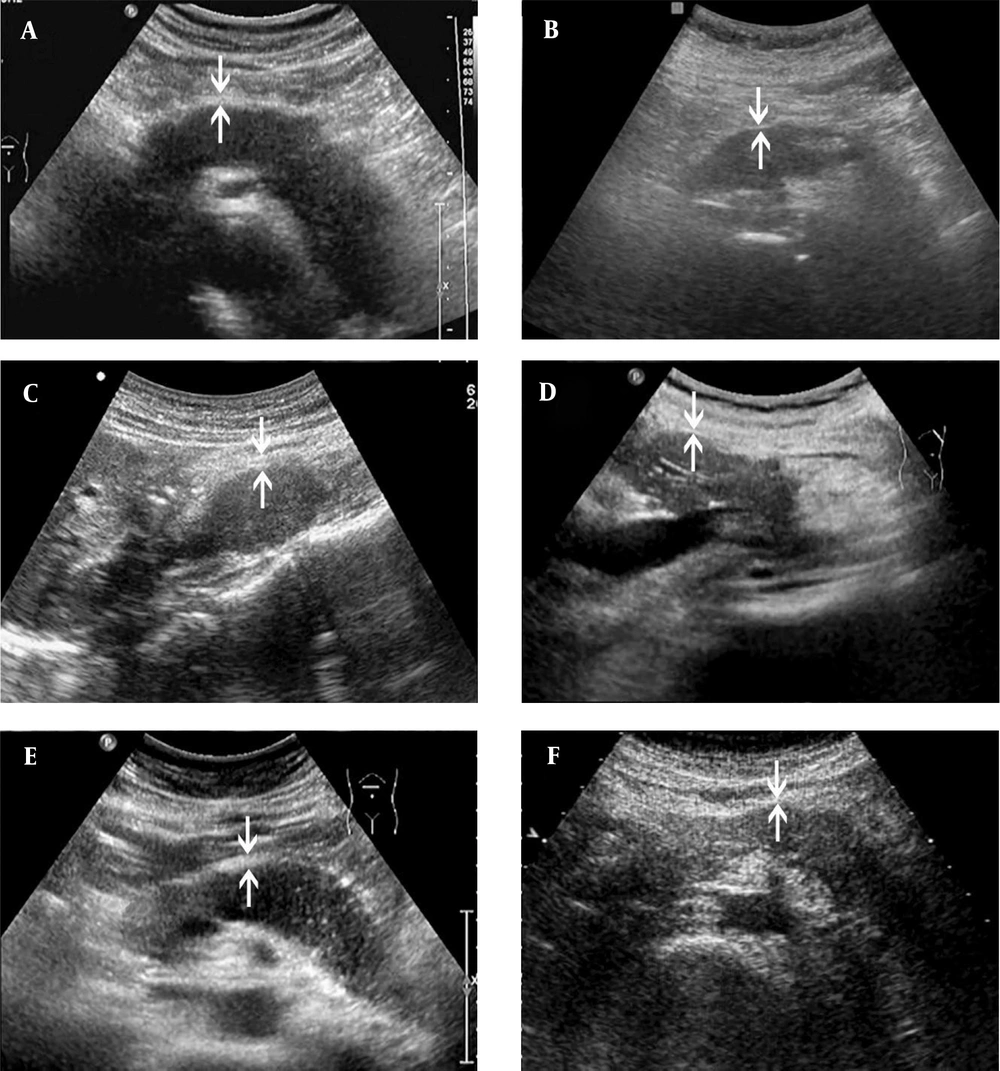 The ultrasonography (US) images of AIP1 and PAC cases. Both AIP1 (A, C & E) and PAC (B, D, F) present as hypoechoic lesions, which involve the entire pancreas (A & B) or are located at the pancreatic head/uncinate process (C & D) or body and tail (E & F). The thickness of the hyperechoic capsule-like structure (arrows) is different between the case and control groups. It is often > 0.41 cm in the AIP1 group (A, 0.43 cm; C, 0.49 cm; E, 0.42 cm) and <0.41 cm in the PAC group (B, 0.24 cm; D, 0.24 cm; F, 0.32 cm) (AIP1, type 1 autoimmune pancreatitis; PAC, pancreatic adenocarcinoma). The ultrasonography (US) images of AIP1 and PAC cases. Both AIP1 (A, C & E) and PAC (B, D, F) present as hypoechoic lesions, which involve the entire pancreas (A & B) or are located at the pancreatic head/uncinate process (C & D) or body and tail (E & F). The thickness of the hyperechoic capsule-like structure (arrows) is different between the case and control groups. It is often > 0.41 cm in the AIP1 group (A, 0.43 cm; C, 0.49 cm; E, 0.42 cm) and <0.41 cm in the PAC group (B, 0.24 cm; D, 0.24 cm; F, 0.32 cm) (AIP1, type 1 autoimmune pancreatitis; PAC, pancreatic adenocarcinoma).