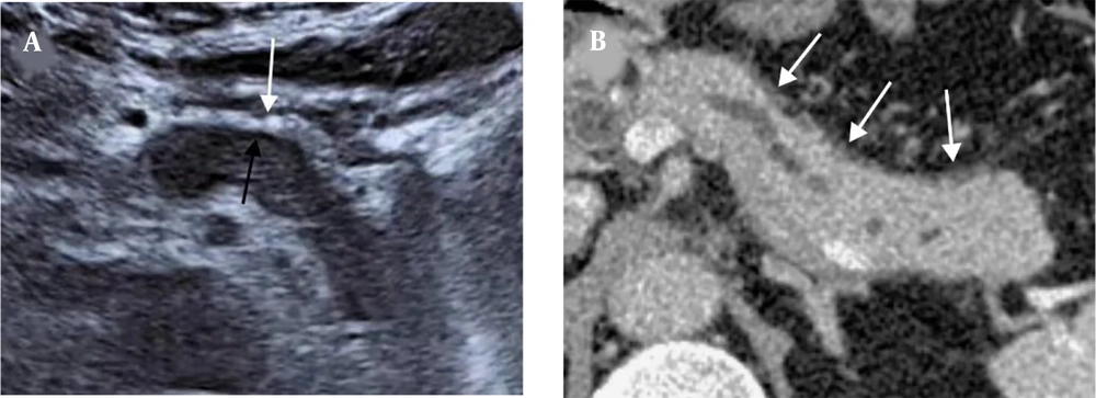 A 62-year-old man with AIP1. A, The US image shows a thick hyperechoic capsule (white arrow) and a thin PHM (black arrow) around the lesion. B, The capsule-like rim sign on the CT scan (white arrows). The thickness of the hyperechoic capsule on the US image is similar to that of the capsule-like rim on the CT scan (0.49 cm vs. 0.51 cm) (AIP1, type 1 autoimmune pancreatitis; US, ultrasonography; PHM, peripancreatic hypoechoic margin; CT, computed tomography). A 62-year-old man with AIP1. A, The US image shows a thick hyperechoic capsule (white arrow) and a thin PHM (black arrow) around the lesion. B, The capsule-like rim sign on the CT scan (white arrows). The thickness of the hyperechoic capsule on the US image is similar to that of the capsule-like rim on the CT scan (0.49 cm vs. 0.51 cm) (AIP1, type 1 autoimmune pancreatitis; US, ultrasonography; PHM, peripancreatic hypoechoic margin; CT, computed tomography).