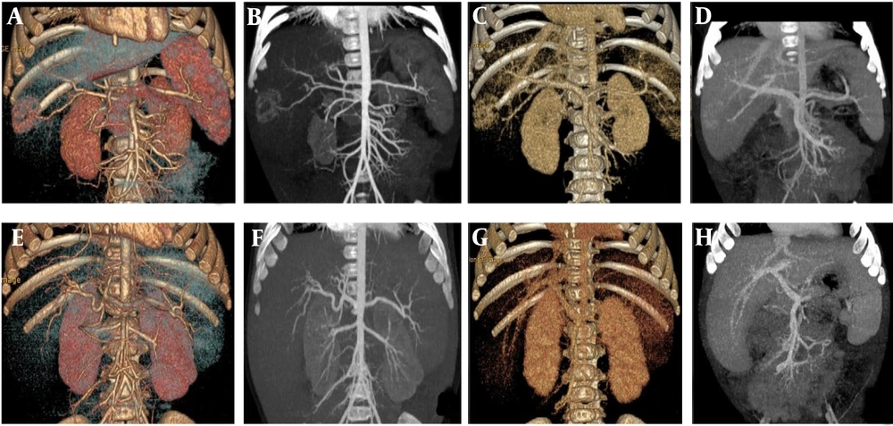 A, B, C, and D are volume rendering (VR) and maximum intensity projection (MIP)min images of the arterial phase and portal veins phase in the control group under scanning conditions. E, F, G, and H are VR and MIPmin images of the arterial phase and portal veins phase in the experimental group under scanning conditions. A, B, C, and D are volume rendering (VR) and maximum intensity projection (MIP)min images of the arterial phase and portal veins phase in the control group under scanning conditions. E, F, G, and H are VR and MIPmin images of the arterial phase and portal veins phase in the experimental group under scanning conditions.