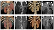 Study of Low kV, Low Contrast Agent Dosage, and Low Contrast Agent Flow Rate Scan in Computed Tomography Angiography of Children's Liver