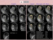 Imaging Evaluation of Clinical and Subclinical Myocarditis in Multisystem Inflammatory Syndrome of Children with COVID-19 Using Cardiac Magnetic Resonance: The Results and Prognosis