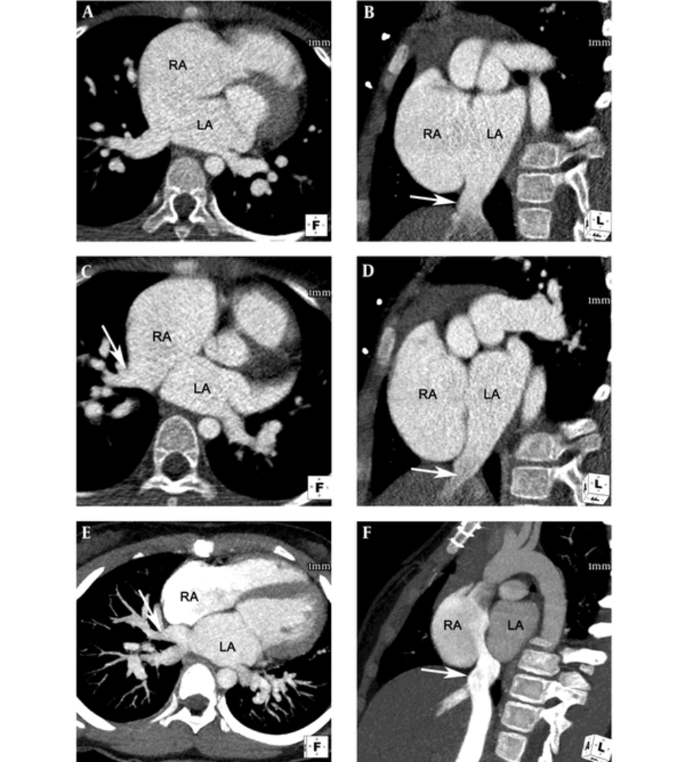 Axial reformatted image (A) and short axis image (B) of retrospective electrocardiogram-gated computed tomography (CT) angiography showed large atrial septal defect (ASD, secundum type) with posterior rim deficiency. The size of the ASD was 3.1 × 3.8 cm. Axial reformatted image (C) showed right superior pulmonary vein (arrow) draining into the right atrium, suggestive of partial anomalous pulmonary venous return (PAPVR). Oblique sagittal reformatted image (D) and short axis image (B) demonstrate the inferior vena cava (IVC) (arrow) draining directly into the left atrium. Maximum intensity projection images of postoperative follow-up CT angiography show successful correction of the ASD, PAPVR, and anomalous drainage of the IVC into the left atrium. Note the superior pulmonary vein (arrow) draining into the left atrium (E) and the IVC (arrow) draining into the right atrium without significant stenosis (F). Axial reformatted image (A) and short axis image (B) of retrospective electrocardiogram-gated computed tomography (CT) angiography showed large atrial septal defect (ASD, secundum type) with posterior rim deficiency. The size of the ASD was 3.1 × 3.8 cm. Axial reformatted image (C) showed right superior pulmonary vein (arrow) draining into the right atrium, suggestive of partial anomalous pulmonary venous return (PAPVR). Oblique sagittal reformatted image (D) and short axis image (B) demonstrate the inferior vena cava (IVC) (arrow) draining directly into the left atrium. Maximum intensity projection images of postoperative follow-up CT angiography show successful correction of the ASD, PAPVR, and anomalous drainage of the IVC into the left atrium. Note the superior pulmonary vein (arrow) draining into the left atrium (E) and the IVC (arrow) draining into the right atrium without significant stenosis (F).