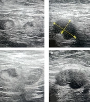 Can Highly Specific Ultrasound Criteria Obviate the Need for Sentinel Lymph Node Biopsy in Breast Cancer Patients with Axillary Lymph Node Metastasis?