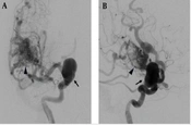 Utilizing the Trans-Cell Approach as a Salvage Treatment for an Unopened Flow Redirection Endoluminal Device in a Flow-Related Aneurysm Associated with Arteriovenous Malformation: A Case Report