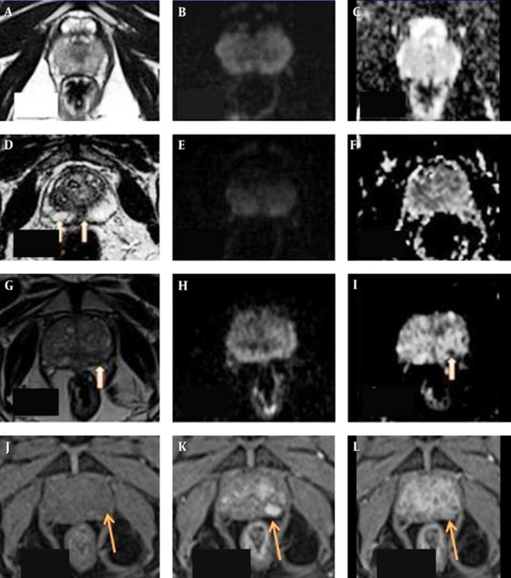 T2-weighted image (T2WI) (A) sequence in axial section reveals uniformly hyper intensity of the peripheral zone of the prostate with no hyper intense signal on diffusion weighted images (B) or hypo intensity on apparent difusion coefficient (ADC) maps (C) giving prostate imaging reporting and dating system (PI-RADS) v2 score of 1 on both T2WI and diffusion weighted imaging (DWI). D shows a wedge shaped faint hypo intensity on T2WI in the peripheral zone in the central and right paracentral location (arrows) with no hyper intense signal on DWI (E) or hypo intensity on ADC maps (F). It was falling under the score of 2 on T2WI and 1 on DWI. As it is located in the peripheral zone, a DWI score of 1 was given finally. Patient had a serum prostate-specific antigen (S.PSA) level of 6.5 ng/mL and underwent biopsy on urologist’s request and with his own consent which was negative for malignancy. T2WI (G) sequence in axial section in another patient reveals a small non-circumscribed indistinct hypo intensity in the peripheral zone of prostate on the left side (arrow), appearing isointense on DWI (H ) with hypointense signal on ADC maps (I) giving PI-RADS v2 score of 3 on T2WI and 3 on DWI . Lesion appears isointense to mildly hyper intense on pre-contrast volumetric interpolated breath-hold examination (VIBE) sequences (arrow in J) and showing early enhancement (K) and early wash out (L) on post contrast sequences- suggestive of positive pattern of enhancement on dynamic contrast enhanced (DCE). The PI-RADS v2 score of the lesion was upgraded from 3 to 4 by adding positive contrast enhancement pattern on DCE. Patient had S. PSA level of 43 ng/mL and biopsy revealed adenocarcioma. Lowest ADC value in the lesion was 0.73mm<sup>2</sup>/s and it was stage T2. T2-weighted image (T2WI) (A) sequence in axial section reveals uniformly hyper intensity of the peripheral zone of the prostate with no hyper intense signal on diffusion weighted images (B) or hypo intensity on apparent difusion coefficient (ADC) maps (C) giving prostate imaging reporting and dating system (PI-RADS) v2 score of 1 on both T2WI and diffusion weighted imaging (DWI). D shows a wedge shaped faint hypo intensity on T2WI in the peripheral zone in the central and right paracentral location (arrows) with no hyper intense signal on DWI (E) or hypo intensity on ADC maps (F). It was falling under the score of 2 on T2WI and 1 on DWI. As it is located in the peripheral zone, a DWI score of 1 was given finally. Patient had a serum prostate-specific antigen (S.PSA) level of 6.5 ng/mL and underwent biopsy on urologist’s request and with his own consent which was negative for malignancy. T2WI (G) sequence in axial section in another patient reveals a small non-circumscribed indistinct hypo intensity in the peripheral zone of prostate on the left side (arrow), appearing isointense on DWI (H ) with hypointense signal on ADC maps (I) giving PI-RADS v2 score of 3 on T2WI and 3 on DWI . Lesion appears isointense to mildly hyper intense on pre-contrast volumetric interpolated breath-hold examination (VIBE) sequences (arrow in J) and showing early enhancement (K) and early wash out (L) on post contrast sequences- suggestive of positive pattern of enhancement on dynamic contrast enhanced (DCE). The PI-RADS v2 score of the lesion was upgraded from 3 to 4 by adding positive contrast enhancement pattern on DCE. Patient had S. PSA level of 43 ng/mL and biopsy revealed adenocarcioma. Lowest ADC value in the lesion was 0.73mm<sup>2</sup>/s and it was stage T2.