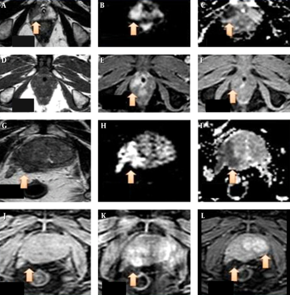There is a wedge shaped altered signal intensity area (arrow) in the peripheral zone on the right side appearing hypointense on T2WI (A) sequence in axial section, appearing hyperintense on DWI (B) and hypointense on apparent difusion coefficient (ADC) maps (C) giving prostate imaging reporting and dating system version 2 (PI-RADS v2) score of 4 on T2WI and 4 on diffusion weighted imaging (DWI). The lesion measures 1.5 × 1.4 × 1.1 cm in size. Image D shows the an isointense lesion to faintly hypo intense on pre-contrast T1WI (arrow) and showing early enhancement (E) and early wash out (F) on post contrast sequences –suggestive of positive pattern of enhancement on DCE. PI-RADS v2 score of 3 was given finally. The patient had serum prostate-specific antigen (S.PSA) level of 25 ng/mL and biopsy revealed adenocarcioma. Lowest ADC value in the lesion was 0.80 mm<sup>2</sup>/s and it was stage T2. T2WI (G) sequence in axial section in another patient reveals a large ill defined hypo intensity in the peripheral zone of prostate on the right side (arrow), appearing hyper intense on DWI (H) with hypo intense signal on ADC maps (I) There is extra capsular extension of the lesion into right neurovascular bundle. It was PI-RADS v2 score 5 lesion. Image (J) shows the lesion to be isointense on pre-contrast T2W high resolution isotropic volume examination (THRIVE) sequences (arrow) and showing early enhancement (K) and early wash out (L) on post contrast sequences- suggestive of positive pattern of enhancement on dynamic contrast enhanced (DCE). Delayed enhancement pattern observed in the left lobe of prostate was a benign adenomatous lesion (L). The patient had an S. PSA level of 190 ng/ml and biopsy revealed adenocarcioma. Lowest ADC value in the lesion was 0.32 mm<sup>2</sup>/s and it was stage T3. There is a wedge shaped altered signal intensity area (arrow) in the peripheral zone on the right side appearing hypointense on T2WI (A) sequence in axial section, appearing hyperintense on DWI (B) and hypointense on apparent difusion coefficient (ADC) maps (C) giving prostate imaging reporting and dating system version 2 (PI-RADS v2) score of 4 on T2WI and 4 on diffusion weighted imaging (DWI). The lesion measures 1.5 × 1.4 × 1.1 cm in size. Image D shows the an isointense lesion to faintly hypo intense on pre-contrast T1WI (arrow) and showing early enhancement (E) and early wash out (F) on post contrast sequences –suggestive of positive pattern of enhancement on DCE. PI-RADS v2 score of 3 was given finally. The patient had serum prostate-specific antigen (S.PSA) level of 25 ng/mL and biopsy revealed adenocarcioma. Lowest ADC value in the lesion was 0.80 mm<sup>2</sup>/s and it was stage T2. T2WI (G) sequence in axial section in another patient reveals a large ill defined hypo intensity in the peripheral zone of prostate on the right side (arrow), appearing hyper intense on DWI (H) with hypo intense signal on ADC maps (I) There is extra capsular extension of the lesion into right neurovascular bundle. It was PI-RADS v2 score 5 lesion. Image (J) shows the lesion to be isointense on pre-contrast T2W high resolution isotropic volume examination (THRIVE) sequences (arrow) and showing early enhancement (K) and early wash out (L) on post contrast sequences- suggestive of positive pattern of enhancement on dynamic contrast enhanced (DCE). Delayed enhancement pattern observed in the left lobe of prostate was a benign adenomatous lesion (L). The patient had an S. PSA level of 190 ng/ml and biopsy revealed adenocarcioma. Lowest ADC value in the lesion was 0.32 mm<sup>2</sup>/s and it was stage T3.