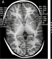 Quantitative Brain MRI Signal Differences in Children with Congenital Portosystemic Shunt Based on 3D T1-Weighted Sequence
