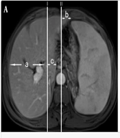Imaging and Pathological Feature Analysis of Idiopathic Portal Hypertension