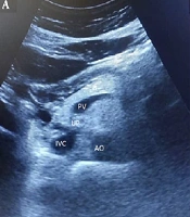 Ultrasound Findings of Liver and Pancreas in Children with Type 1 Diabetes Mellitus: A Case-Control Study