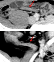 Key Factors for Predicting Appendicitis from Contrast-Enhanced Computed Tomography Images Obtained Through Multiplanar Reconstruction