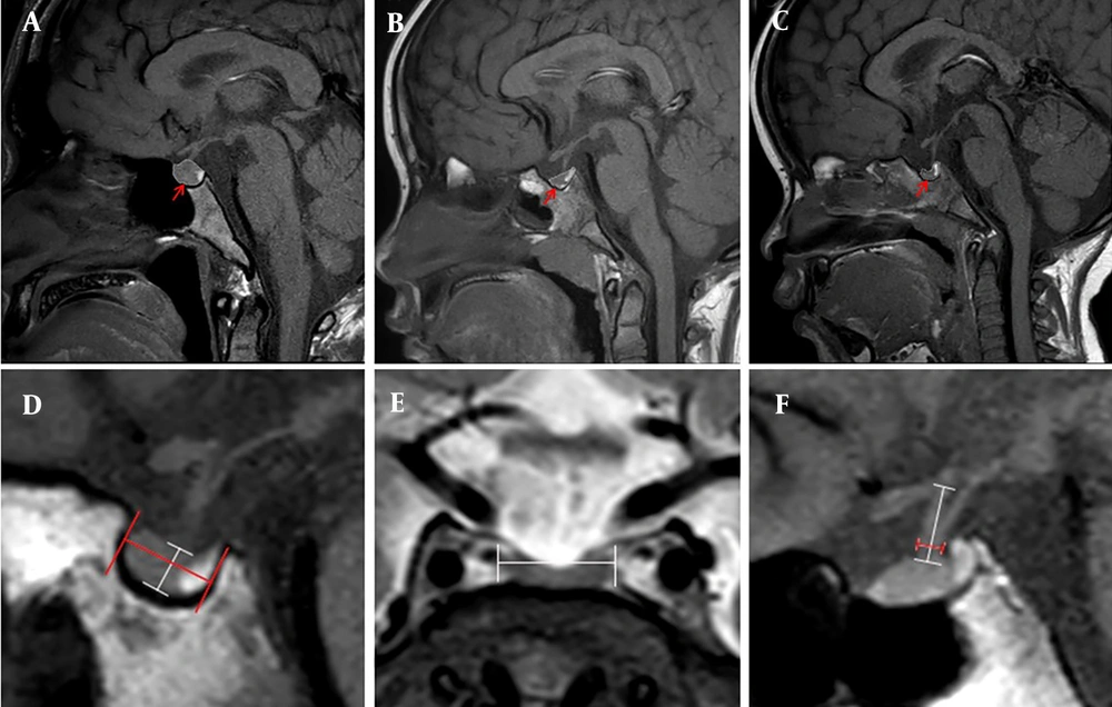 The morphology and assessment of the pituitary gland (PG). A, Convex type; B, Flat type; C, Concave type; D, The height and length of the PG; E, The width of the PG; F, The diameter and length of the pituitary stalk; A, B, C, D, and F images are sagittal T1 weighted imaging, while E image is coronal T2 weighted imaging. The morphology and assessment of the pituitary gland (PG). A, Convex type; B, Flat type; C, Concave type; D, The height and length of the PG; E, The width of the PG; F, The diameter and length of the pituitary stalk; A, B, C, D, and F images are sagittal T1 weighted imaging, while E image is coronal T2 weighted imaging.
