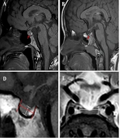 Cover image of the article: Pituitary Gland Morphology: A Novel Diagnostic Marker for Differentiating Growth Hormone Deficiency from Idiopathic Short Stature in Children