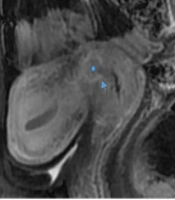 The Accuracy of Arterial Phase of Dynamic Contrast-Enhanced Magnetic Resonance Imaging in Predicting Cervical Stromal Invasion in Patients with Endometrial Carcinoma