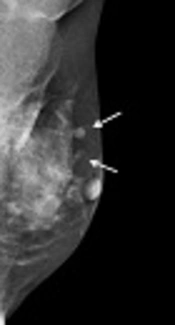Cover image of the article: Multimodality Imaging of Charcoal Granuloma Mimicking Breast Cancer Recurrence
