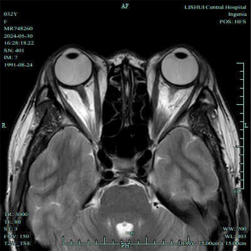 Cross-sectional measurement of extraocular muscles (EOMs) Cross-sectional measurement of extraocular muscles (EOMs)