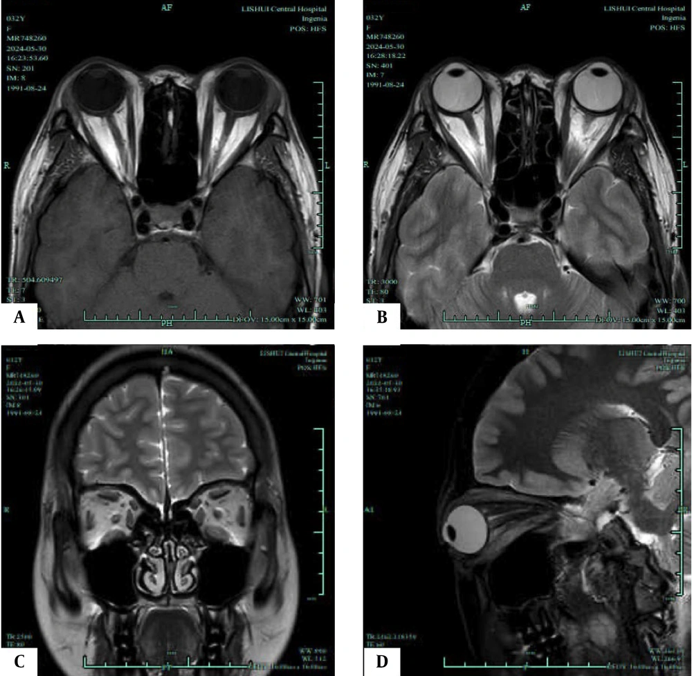 T1/T2-weighted magnetic resonance imaging (MRI) of an active phase patient. A, Axial T1-weighted MRI shows the most distinct visualization of the enlarged extraocular muscles (EOMs) during the active phase; B, Axial T2-weighted MRI highlights the same EOMs; C, Coronal T2-weighted MRI shows the most distinct visualization of the enlarged EOMs during the progression phase; D, Sagittal T2-weighted MRI highlights the same EOMs. T1/T2-weighted magnetic resonance imaging (MRI) of an active phase patient. A, Axial T1-weighted MRI shows the most distinct visualization of the enlarged extraocular muscles (EOMs) during the active phase; B, Axial T2-weighted MRI highlights the same EOMs; C, Coronal T2-weighted MRI shows the most distinct visualization of the enlarged EOMs during the progression phase; D, Sagittal T2-weighted MRI highlights the same EOMs.