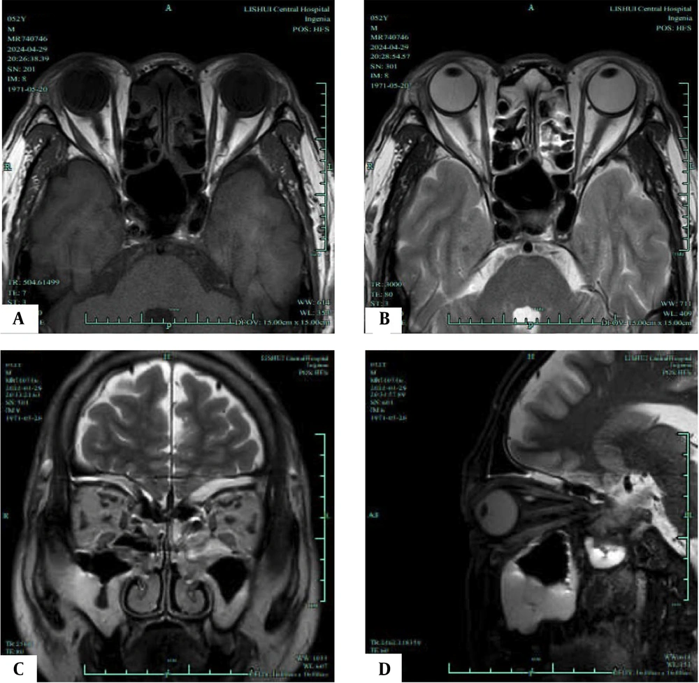 T1/T2-weighted magnetic resonance imaging (MRI) of an inactive phase patient. A, Axial T1-weighted MRI shows the most distinct visualization of the enlarged extraocular muscles (EOMs) during the inactive phase; B, Axial T2-weighted MRI highlights the same EOMs; C, Coronal T2-weighted MRI shows the most distinct visualization of the enlarged EOMs during the progression phase; D, Sagittal T2-weighted MRI highlights the same EOMs. T1/T2-weighted magnetic resonance imaging (MRI) of an inactive phase patient. A, Axial T1-weighted MRI shows the most distinct visualization of the enlarged extraocular muscles (EOMs) during the inactive phase; B, Axial T2-weighted MRI highlights the same EOMs; C, Coronal T2-weighted MRI shows the most distinct visualization of the enlarged EOMs during the progression phase; D, Sagittal T2-weighted MRI highlights the same EOMs.
