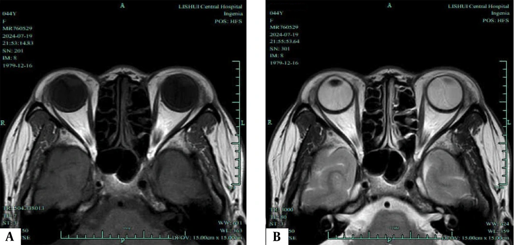 Axial T1/T2-weighted magnetic resonance imaging (MRI) of a progression phase. A, Axial T1-weighted MRI shows the most distinct visualization of the enlarged extraocular muscles (EOMs) during the progression phase; B, Axial T2-weighted MRI highlights the same EOMs Axial T1/T2-weighted magnetic resonance imaging (MRI) of a progression phase. A, Axial T1-weighted MRI shows the most distinct visualization of the enlarged extraocular muscles (EOMs) during the progression phase; B, Axial T2-weighted MRI highlights the same EOMs