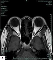 Diagnostic Accuracy of MRI-Based Dixon and T2 Localization Techniques for Imaging Severity and Progression in Thyroid-Associated Ocular Diseases