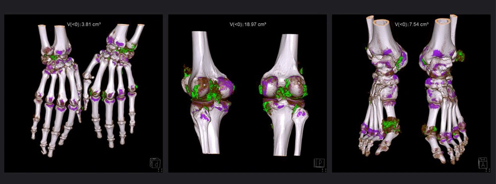Dual-energy CT reconstruction of bilateral wrists/hands, knees, and ankles/feet in a 54-year-old patient with a gout duration of 10 years. After excluding of nail bed, skin, and beam hardening artifacts, the numbers displayed on the top of the images indicated the volume quantification of monosodium urate crystal. Monosodium urate crystal deposition is color-coded as green. Dual-energy CT reconstruction of bilateral wrists/hands, knees, and ankles/feet in a 54-year-old patient with a gout duration of 10 years. After excluding of nail bed, skin, and beam hardening artifacts, the numbers displayed on the top of the images indicated the volume quantification of monosodium urate crystal. Monosodium urate crystal deposition is color-coded as green.
