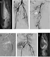 Uterine Artery Embolization for Leiomyoma in Patient with Absent Unilateral Internal Iliac Artery Due to Previous Kidney Transplantation: Embolization via Lumbar Artery Collaterals