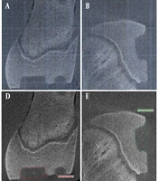 Evaluating Cross-sectional Accuracy of Volumetric Calculations for Intraosseous Defects in Cone-beam Computed Tomography: Effects of Slice Intervals and Section Orientation Using Planimetry and Point Counting