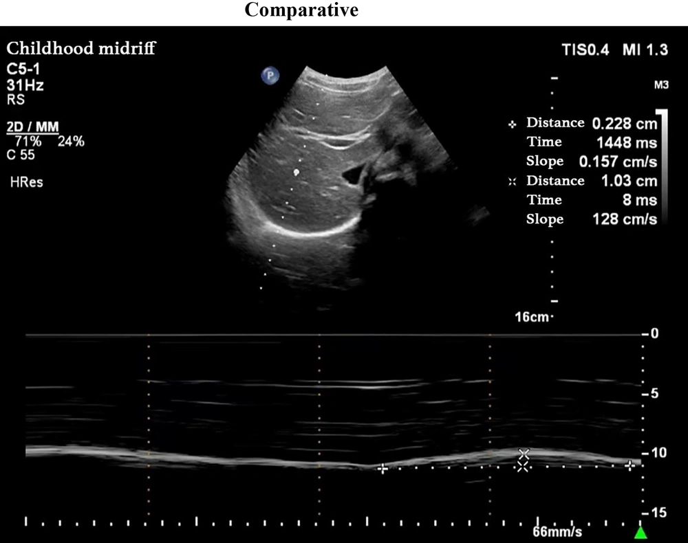Measurement of diaphragm excursion; probe position: The low frequency convex array probe (1 - 5 MHz) was placed under the right clavicular midline and costal margin, with the liver as the acoustic window; measurement method: The B-mode was used to determine where the diaphragm displacement was the largest, and the M-mode was switched. The sampling line was perpendicular to the diaphragm, and the displacement curve of the diaphragm with breathing was recorded; figure meaning: The highest point of the curve represents the position of the diaphragm at the end of inspiration, the lowest point represents the position of the diaphragm at the end of expiratory breath, and the distance between the two is the diaphragm excursion. Measurement of diaphragm excursion; probe position: The low frequency convex array probe (1 - 5 MHz) was placed under the right clavicular midline and costal margin, with the liver as the acoustic window; measurement method: The B-mode was used to determine where the diaphragm displacement was the largest, and the M-mode was switched. The sampling line was perpendicular to the diaphragm, and the displacement curve of the diaphragm with breathing was recorded; figure meaning: The highest point of the curve represents the position of the diaphragm at the end of inspiration, the lowest point represents the position of the diaphragm at the end of expiratory breath, and the distance between the two is the diaphragm excursion.