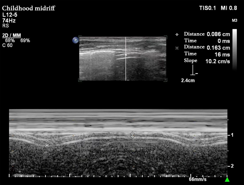 Measurement of diaphragm thickness; probe position: The high-frequency linear array probe (3 - 12 MHz) was placed in the area between the right midaxillary line and the 8 - 10 ribs, with the liver as the sound window; measurement methods: The B-type mode was used to obtain the high-low-three-layer echo structure of the diaphragm, and the M-type mode was switched. The sampling line was perpendicular to the diaphragm, and the curve of the thickness of the diaphragm with breathing was recorded; figure meaning: The two high echo lines represent the parietal pleural line and the peritoneal line respectively, and the low echo area in the middle is the diaphragm. The end expiratory thickness (Tee) was the minimum diaphragm thickness, and the end inspiratory thickness (Tei) was the maximum diaphragm thickness. Measurement of diaphragm thickness; probe position: The high-frequency linear array probe (3 - 12 MHz) was placed in the area between the right midaxillary line and the 8 - 10 ribs, with the liver as the sound window; measurement methods: The B-type mode was used to obtain the high-low-three-layer echo structure of the diaphragm, and the M-type mode was switched. The sampling line was perpendicular to the diaphragm, and the curve of the thickness of the diaphragm with breathing was recorded; figure meaning: The two high echo lines represent the parietal pleural line and the peritoneal line respectively, and the low echo area in the middle is the diaphragm. The end expiratory thickness (Tee) was the minimum diaphragm thickness, and the end inspiratory thickness (Tei) was the maximum diaphragm thickness.
