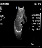 Comparative Role of Diaphragmatic Ultrasound in Predicting Weaning Outcomes: A Case-Control Study in Pediatric Patients on Mechanical Ventilation