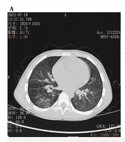 Comparative Effects of Model-Based and Adaptive Statistical Iterative Reconstruction Algorithms on Image Quality Metrics in Low-Dose Chest Computed Tomography for Pediatric Pneumonia: A Prospective Study