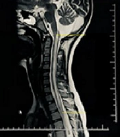 A Case-Control Study on the Relationship Between Lesion Burden and Expanded Disability Status Scale in Aquaporin-4-Positive and Aquaporin-4-Negative Neuromyelitis Optica Spectrum Disorder Patients