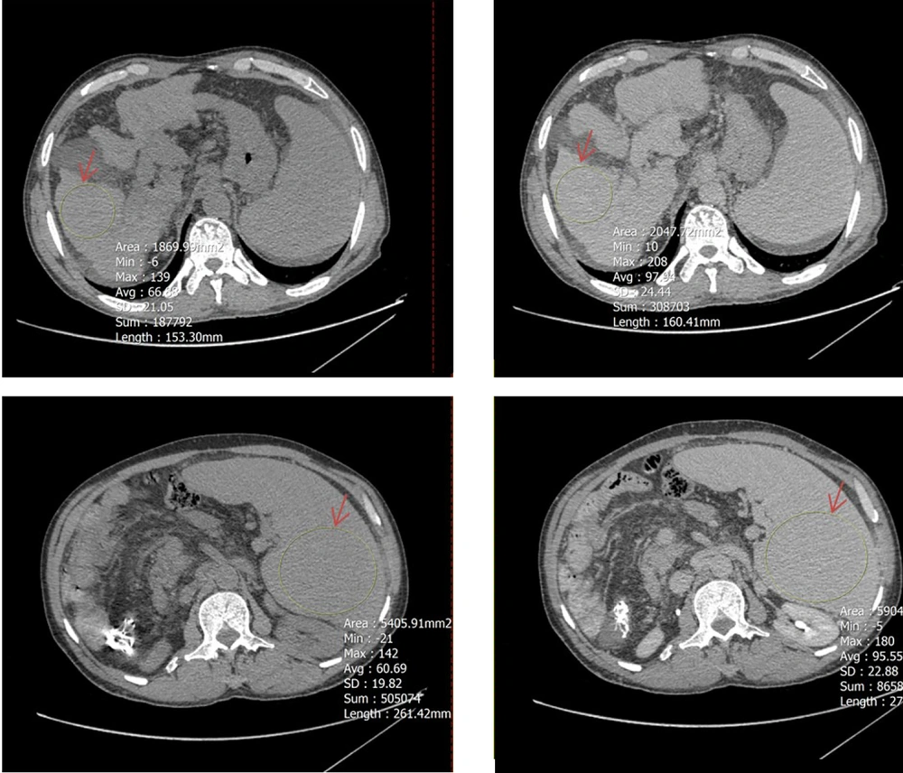 A circular region of interest (ROI, indicated by red arrows) was placed as large as possible on axial computed tomography (CT) images in both noncontrast (left) and equilibrium (right) phases. The upper panels show ROI placement in the right hepatic lobe at the level of the porta hepatis, while the lower panels demonstrate ROI positioning within the spleen at its maximum cross-sectional area, excluding visible vessels and focal lesions. A circular region of interest (ROI, indicated by red arrows) was placed as large as possible on axial computed tomography (CT) images in both noncontrast (left) and equilibrium (right) phases. The upper panels show ROI placement in the right hepatic lobe at the level of the porta hepatis, while the lower panels demonstrate ROI positioning within the spleen at its maximum cross-sectional area, excluding visible vessels and focal lesions.
