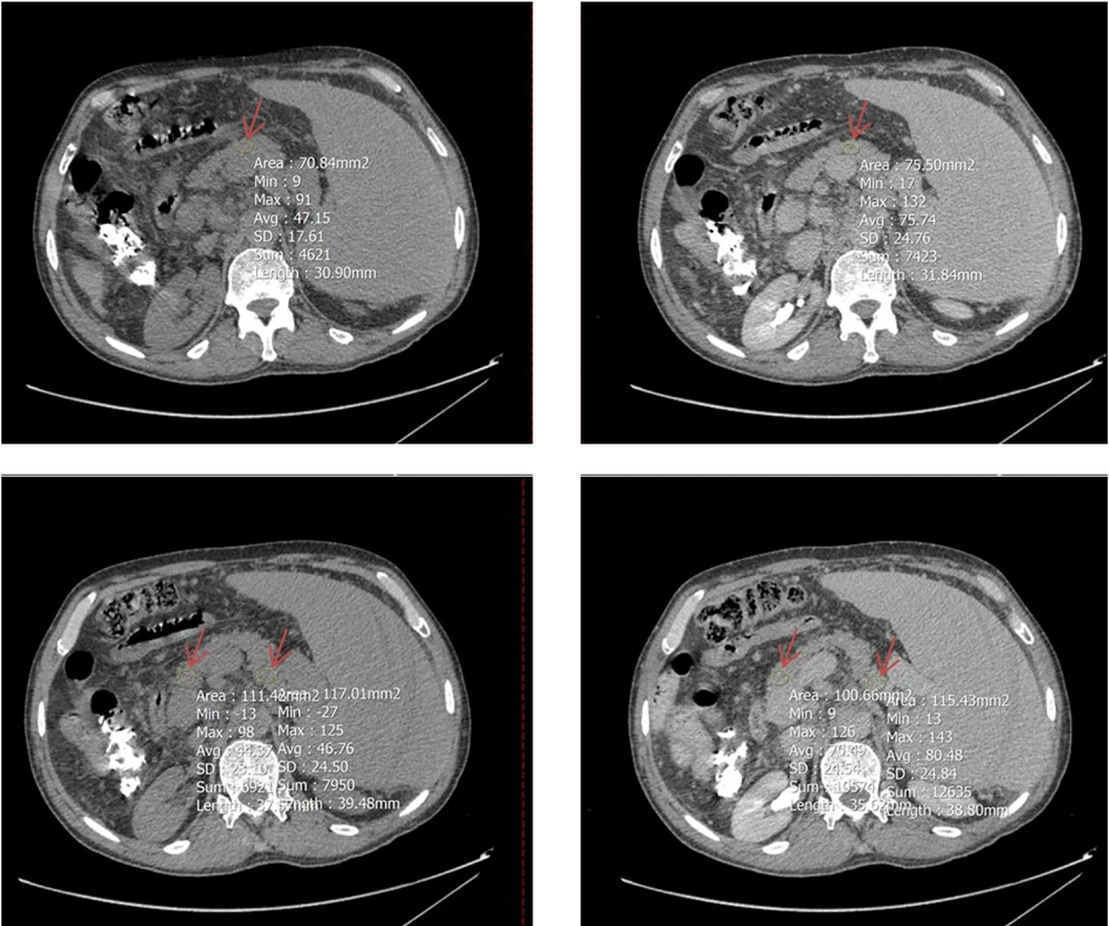 A circular region of interest (ROI, indicated by red arrow) was positioned as large as possible on Axial computed tomography (CT)-scan images (left: Non-contrast phases, right: Equilibrium phases) at three segments of the pancreas: Head and tail (two lower images) and body (two upper images); the average HU value from these parts was used to represent the entire organ. A circular region of interest (ROI, indicated by red arrow) was positioned as large as possible on Axial computed tomography (CT)-scan images (left: Non-contrast phases, right: Equilibrium phases) at three segments of the pancreas: Head and tail (two lower images) and body (two upper images); the average HU value from these parts was used to represent the entire organ.