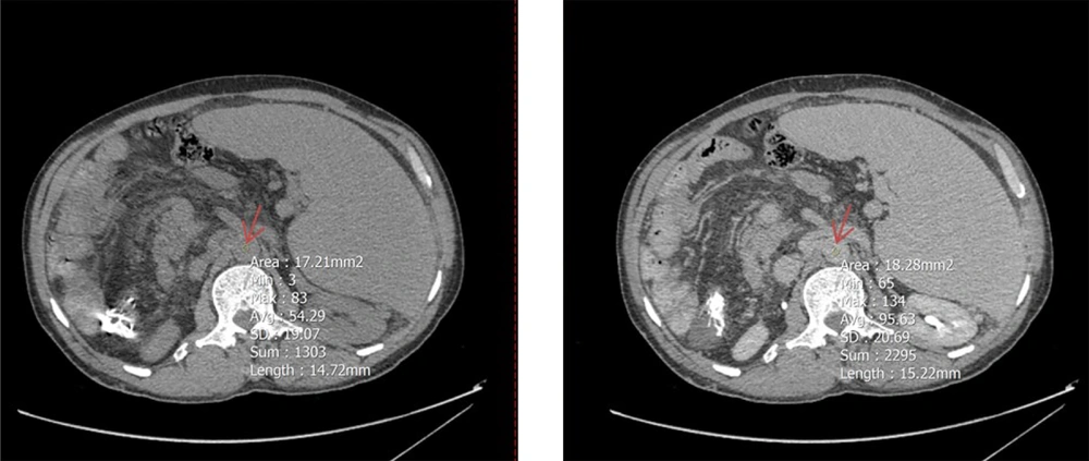 A circular region of interest (ROI, 15 mm in diameter; indicated by red arrow) was placed at the center of the abdominal aorta at the level of the renal artery origin on axial computed tomography (CT) images. The left panel corresponds to the noncontrast phase, and the right panel depicts the equilibrium phase. A circular region of interest (ROI, 15 mm in diameter; indicated by red arrow) was placed at the center of the abdominal aorta at the level of the renal artery origin on axial computed tomography (CT) images. The left panel corresponds to the noncontrast phase, and the right panel depicts the equilibrium phase.