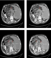 Spleen Extracellular Volume Fraction on Computed Tomography as a Noninvasive Predictor of High-Risk Esophageal Varices in Patients with Cirrhosis