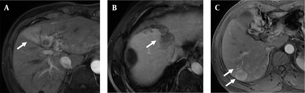 Typical images of A, Arterial peritumoral enhancement; B, Non-smooth margin; and C, Multifocality. Arrows indicate the characteristic radiological features. Typical images of A, Arterial peritumoral enhancement; B, Non-smooth margin; and C, Multifocality. Arrows indicate the characteristic radiological features.