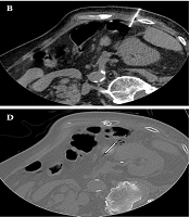 Advancing Safety in CT-Guided Biopsies: A Case Study of the Stylet-Free Coaxial Needle Technique for Displacement of Non-target Tissues