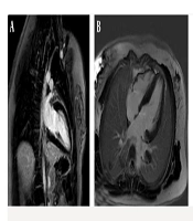Cardiac Involvement in Friedreich’s ataxia: A Case Series Highlighting Imaging Findings