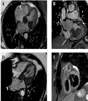 Cardiac Inflammatory Pseudotumor Following Atrial Septal Defect Repair: A Rare Complication Managed with Sirolimus and Bevacizumab