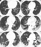 Assessing Machine Learning Classifiers in COVID-19: The Role of Clinical, Laboratory, and Radiological Features in Predicting Oxygen Saturation