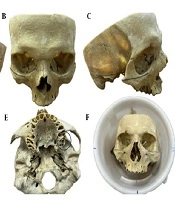 Optimizing MRI Protocols with Metal Artifact Reduction Sequences in Dental Implants: An In Vitro Study on Dry Human Skull at 1.5 T